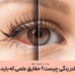 عوارض لنز رنگی چیست؟ حقایق علمی که باید بدانید!
