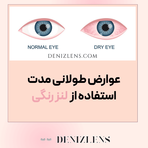 عوارض طولانی مدت لنز رنگی